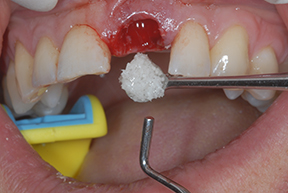 OSSIFY Mineralized Cortical Cancellous Bone Allograft – Large Particle | Surgical Esthetics | Surgical Esthetics Bone Graft OSSIFY Mineralized Cortical Cancellous Bone Allograft – Large Particle | Surgical Esthetics | Surgical Esthetics Bone Graft