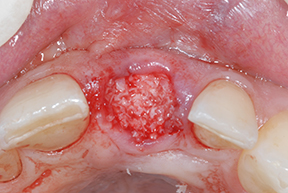 OSSIFY Mineralized Cortical Cancellous Bone Allograft – Large Particle | Surgical Esthetics | Surgical Esthetics Bone Graft OSSIFY Mineralized Cortical Cancellous Bone Allograft – Large Particle | Surgical Esthetics | Surgical Esthetics Bone Graft