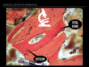 Bone Graft Quality | Surgical Esthetics | Surgical Esthetics Bone Graft Bone Graft Quality | Surgical Esthetics | Surgical Esthetics Bone Graft